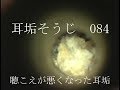 耳垢そうじ/聞こえが悪くなった耳垢/084