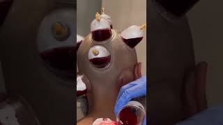 Cupping therapy || Hijama on the head || Wet cupping #shorts