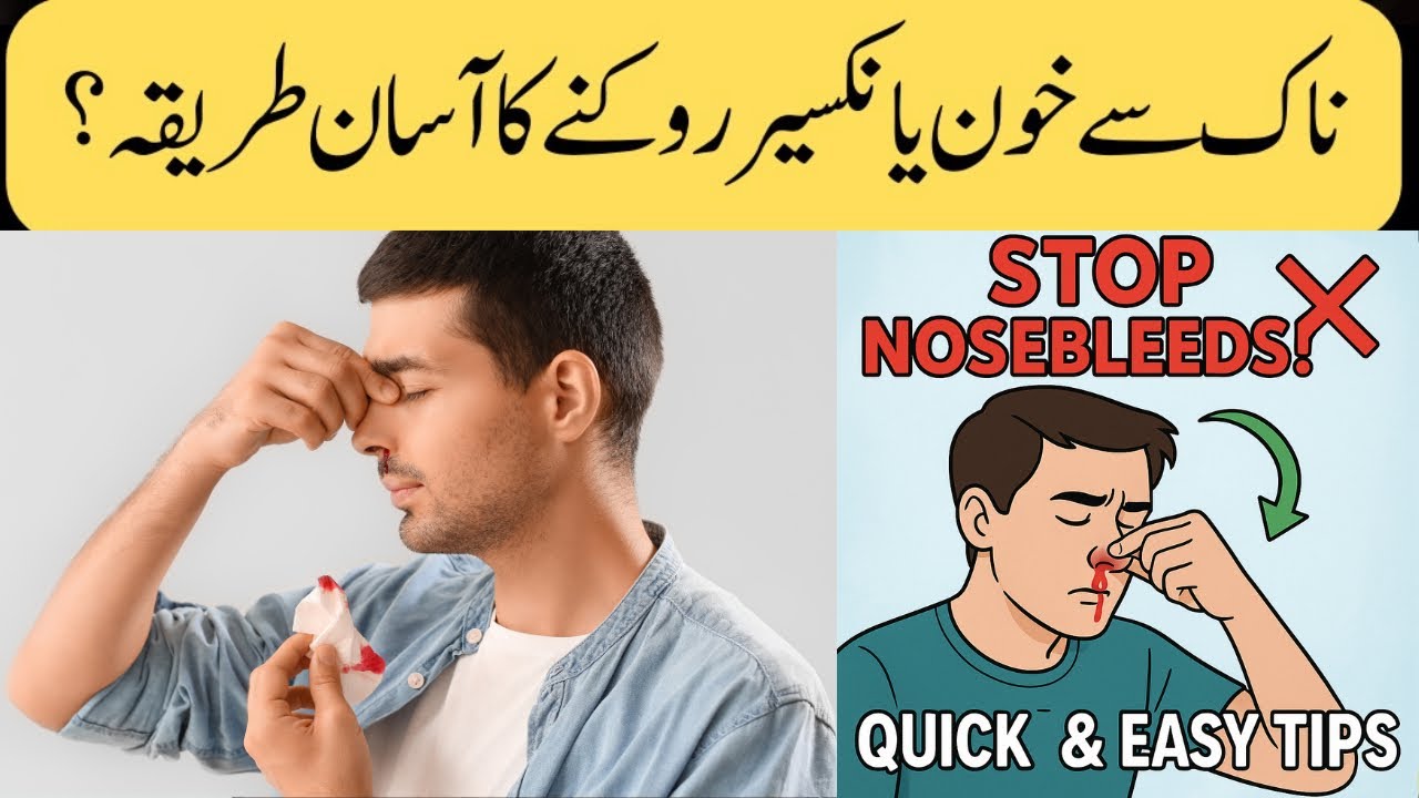 Nosebleed Hacks: Stop It Fast!Nakseer ka fori ilaj