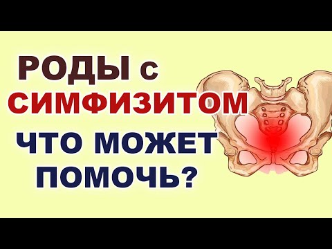 Роды с симфизитом. Избежать Кесарева. Можно ли вылечить симфизит? Упражнения при симфизите.