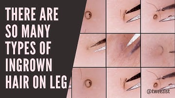 [Tweezist] Plucking ingrown hairs 매몰모(인그로운 헤어) 뽑기