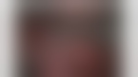 RETROPERITONEOSCOPIC PYELOLITHOTOMY FOR A GIANT PELVIS STONE