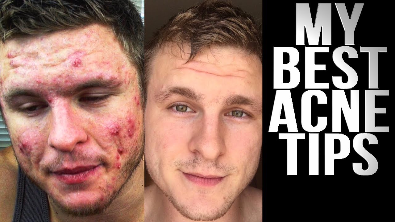 WATCH THIS IF YOU HAVE ACNE!