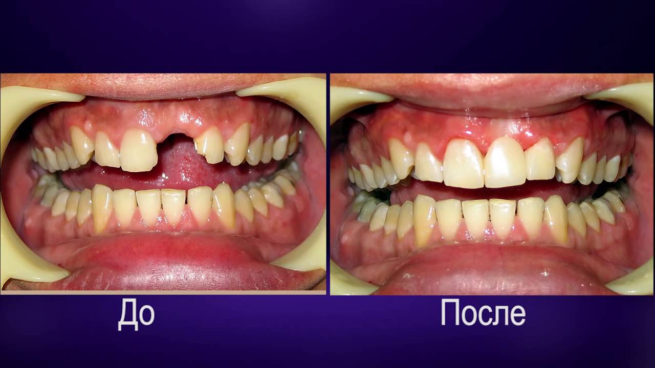 Какие есть виды протезирования зубов? - YouTube