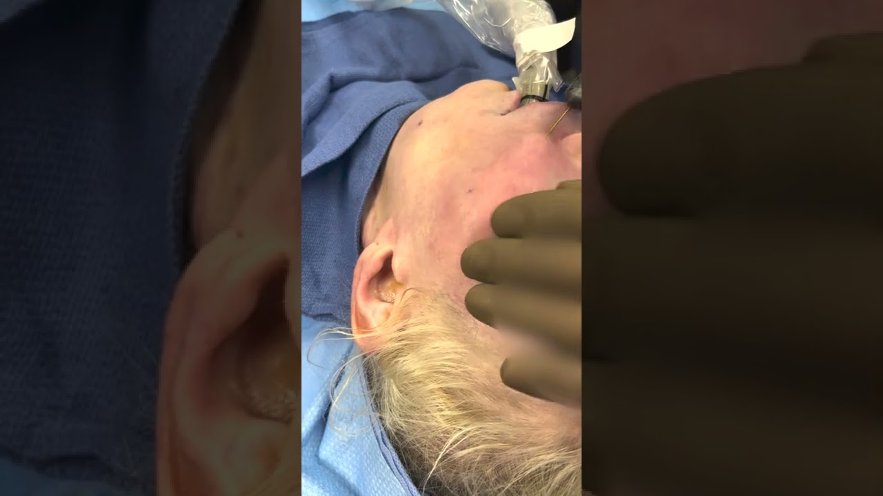 Fat grafting, a natural way to restore volume on your face!