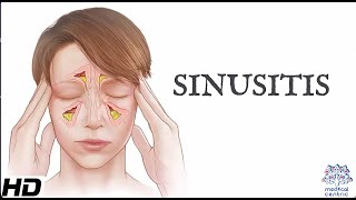 Sinusitis: Everything You Need To Know