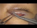 ※手術動画※ 上眼瞼の睫毛内反への手術 10 mins Asian Upper eyelid blepharoplasty