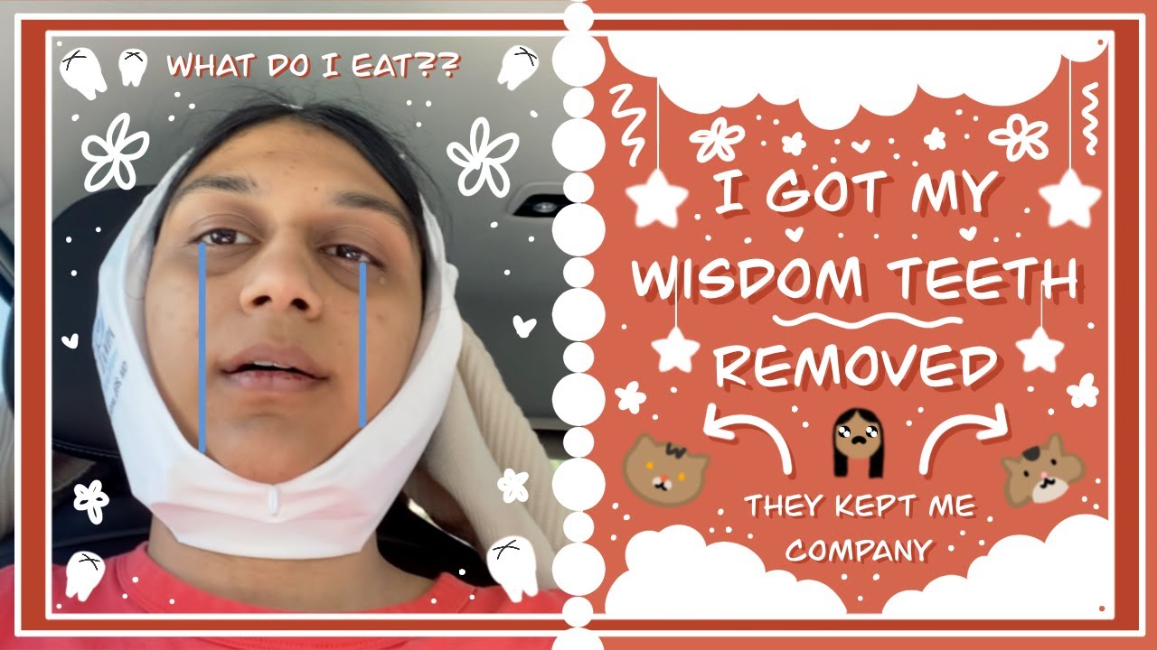 WISDOM TEETH REMOVAL RECOVERY What to eat after wisdom teeth removed