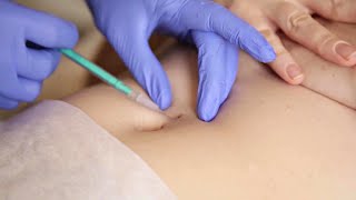 Needle Poke and Belly Button (Navel) piercing procedure | Navel Play