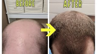 strimmel Stor mængde åndelig CRAZY MICRONEEDLING RESULTS TO STOP BALDING AND HAIR LOSS! - YouTube