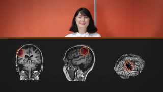SENSe: Study of the Effectiveness of Neurorehabilitation on Sensation