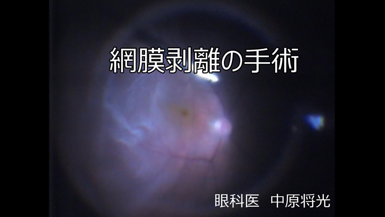 網膜剥離の硝子体手術 執刀医を選ぶように。成績は術者によって差がで