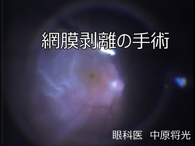 網膜剥離の硝子体手術 執刀医を選ぶように。成績は術者によって差がで