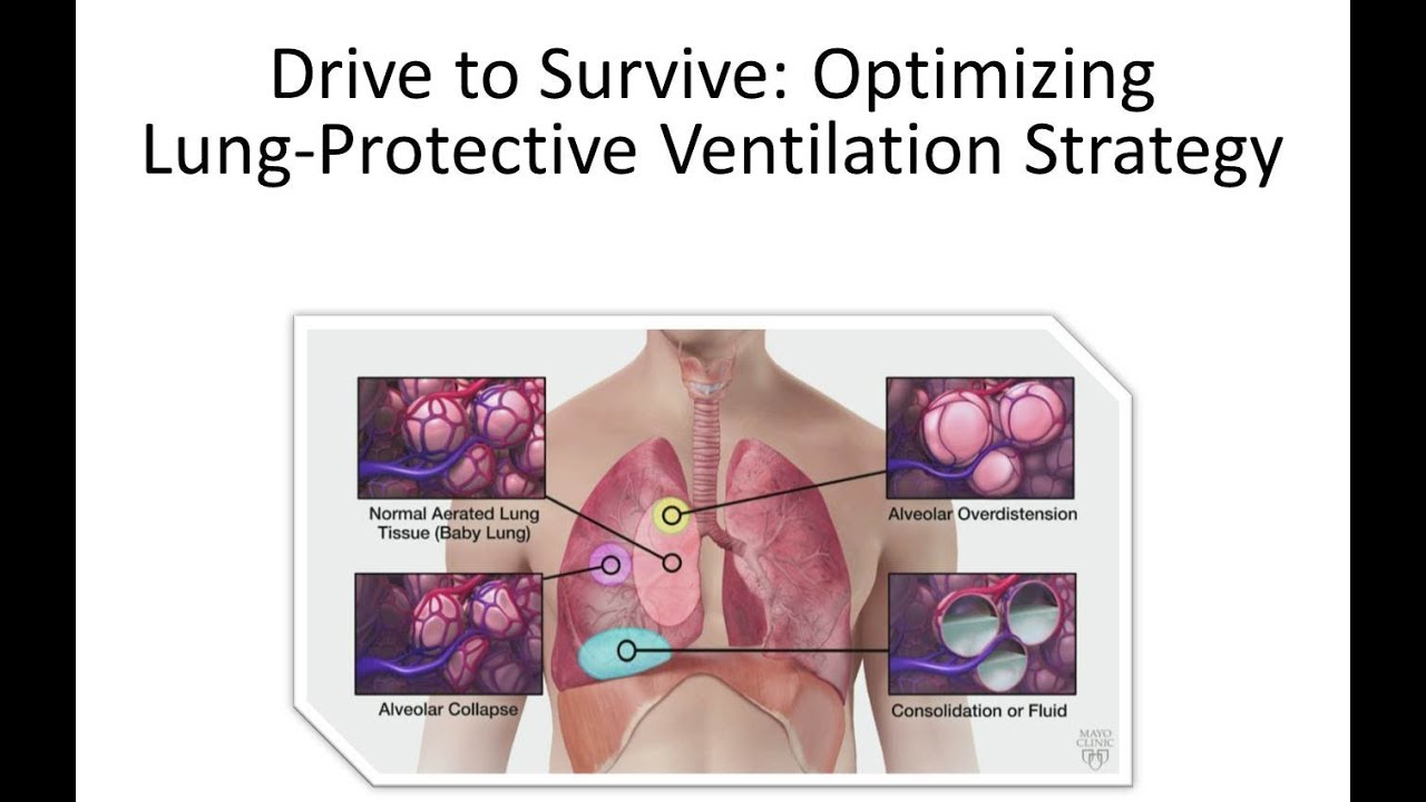 Drive to Survive Optimizing lung protective ventilation strategy