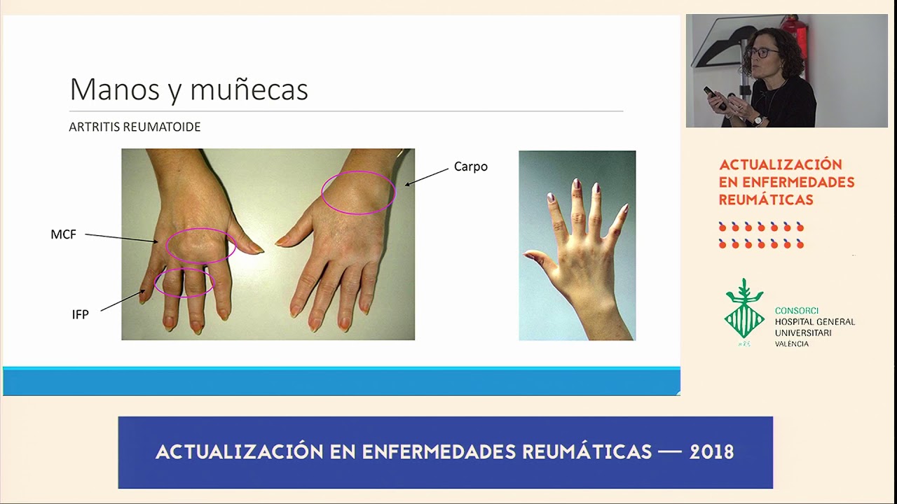 Artrosis y artritis de manos, diferencias - Advansur Traumatología