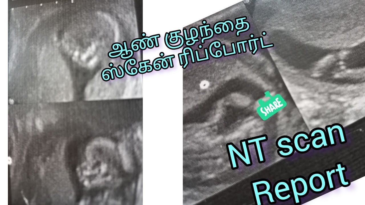 NT Scan In Tamil 3rd Month Scan Report In Tamil Boy Baby Symptoms nt-scan-in-tamil-3rd-month-scan-report-in-tamil-boy-baby-symptoms