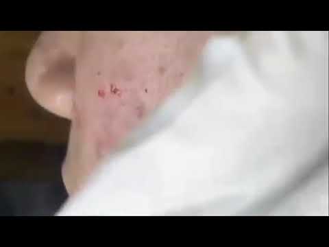BLACKHEADS ACNE EXTRACTION | Mesmerizing to watch!