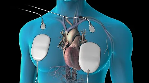 ¿Se seda a los pacientes para la cardioversión?