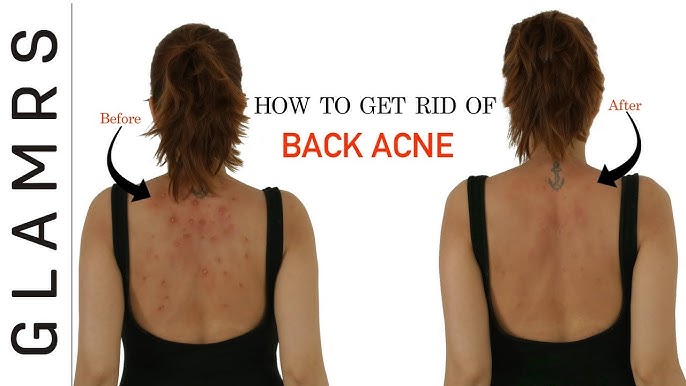 Treat Back Acne Naturally Effective Home 2024