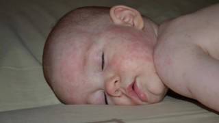 Кашель как симптом аллергической реакции у ребёнка и его лечение + видео