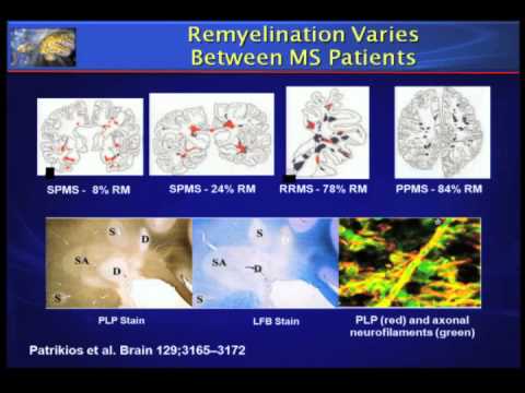 Hope for Progressive MS 2012 by Fred Lublin, MD neurology department