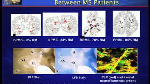 Hope for Progressive MS 2012 by Fred Lublin, MD