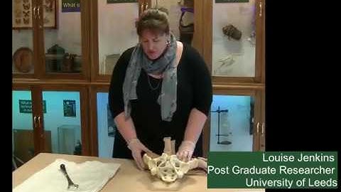 The Vectis in Obstructed Labour: A Case History