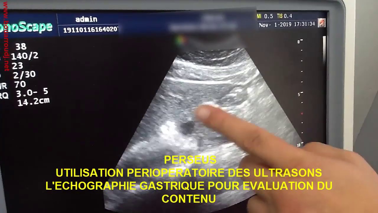 Échographie gastrique pour évaluation du contenu. YouTube