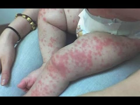 Video: Il virus coxsackie è curabile?