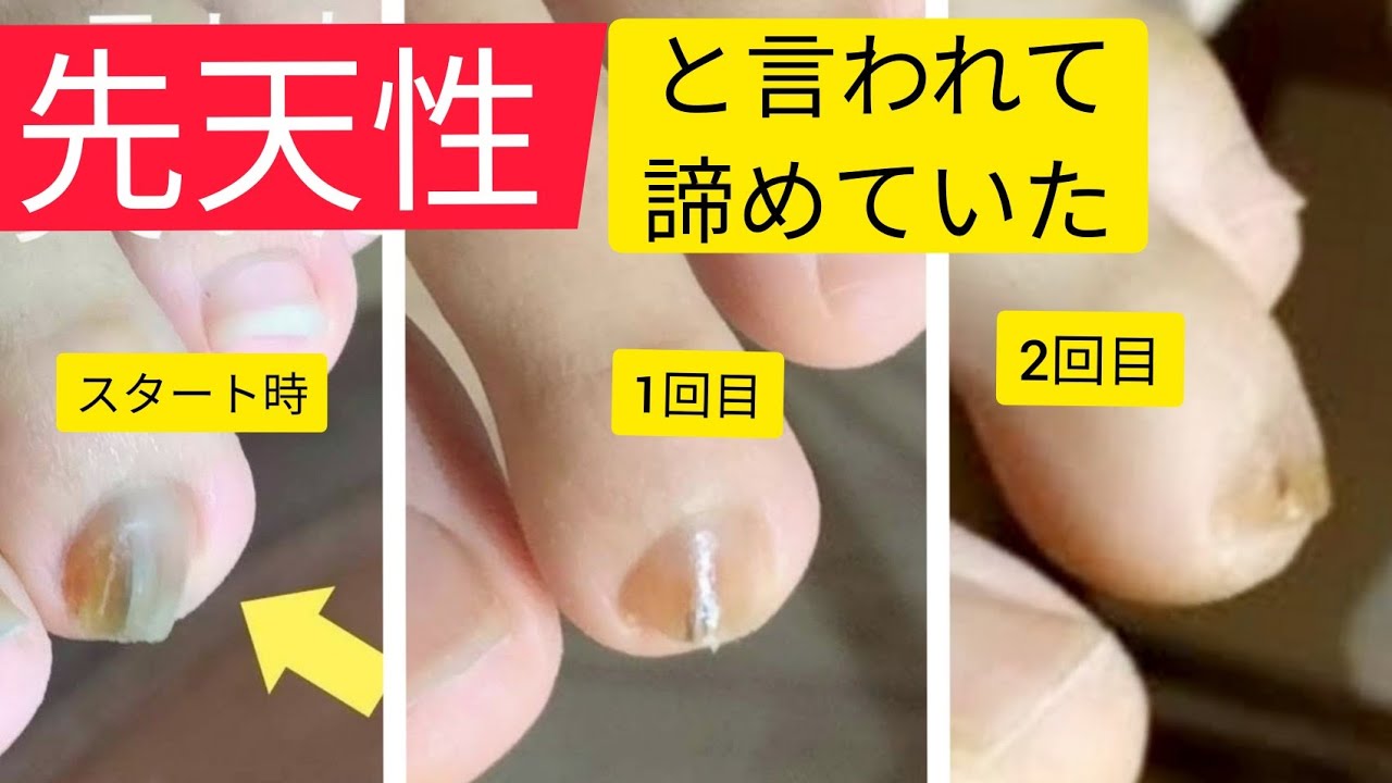 ただ足爪の間の角質を取る短い動画 Pedicure Vol 37 Youtube