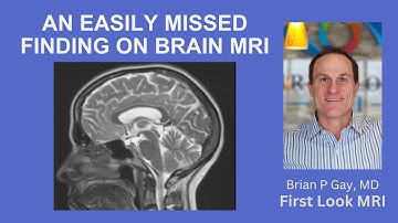 AN EASILY MISSED FINDING ON BRAIN MRI