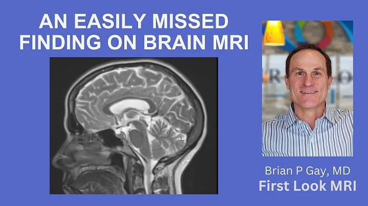 AN EASILY MISSED FINDING ON BRAIN MRI