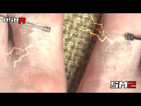 【掻いて気持ち良くなるアトピー性皮膚炎ASMR】超痒い脚の親指をWで掻く音/癒し/リラックス効果/睡眠導入/マッサージ