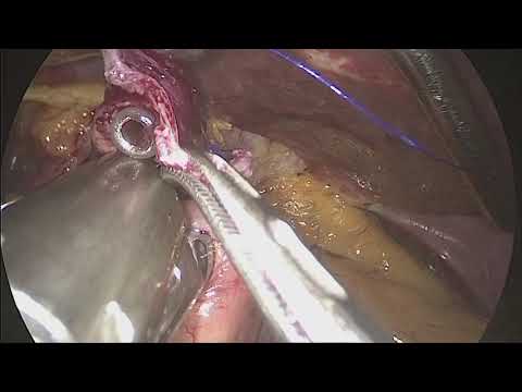 Double tract reconstruction for proximal gastrectomy
