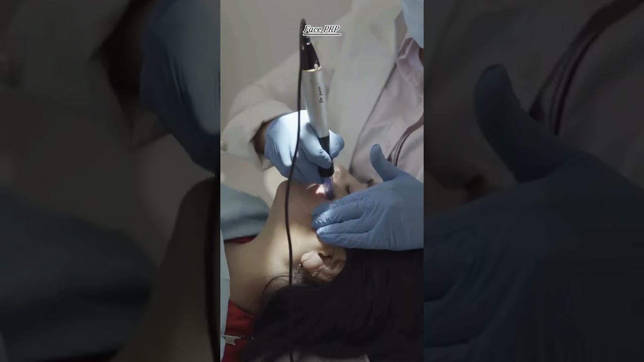 PRP Face Treatment in Pune 🔥 | No Filters Needed for Glowing Skin ✨ | UNO Salon & Clinic 