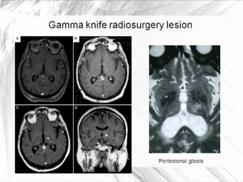 Gamma Knife Thalamotomy for Medically-Refractory Tremor in Patients not Suitable for DBS