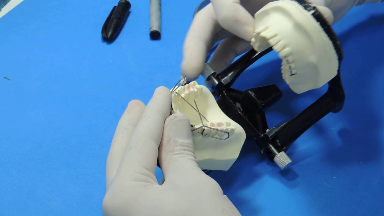 Conversão do arco para o pálato