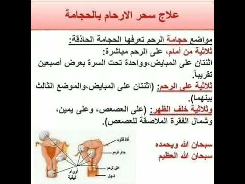 علاج سحر الرحم بالحجامة