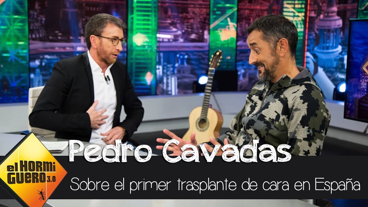 Pedro Cavadas sobre el primer trasplante de cara realizado en España  - El Hormiguero 3.0