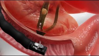 10 Tips for doing a Safe ERCP