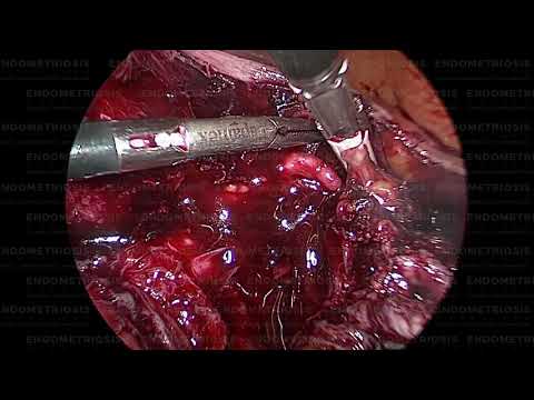 Ejemplo de cirugia minimamente invasiva