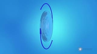 What is a multifocal toric intraocular lens (IOL)?