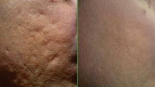 Please watch: "warning. you're being lied to."
https://www./watch?v=z1lovmzixm0 -~-~~-~~~-~~-~- believe me i know the
pain of acne and breakouts. ...