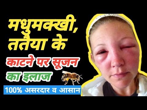 #healthtipsinhindi #gharelunuskhe 🐝मधुमक्खी काटने से सूजन का इलाज| Bhird ke katne par kya kare