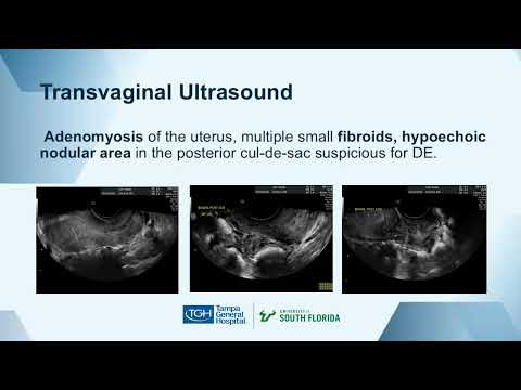 Precision Surgery for Colorectal Deep Endometriosis: Complete Excision Without Segmental Bowel..