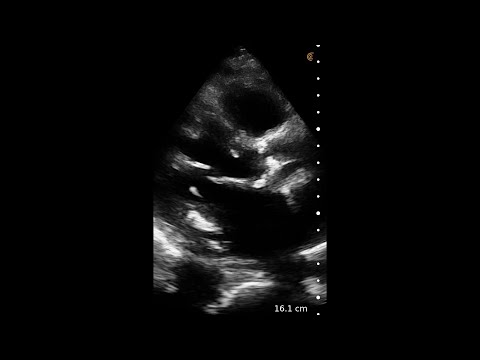 Image of Aortic Stenosis