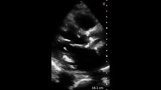 Aortic Stenosis – Ultrasound Image Interpretation