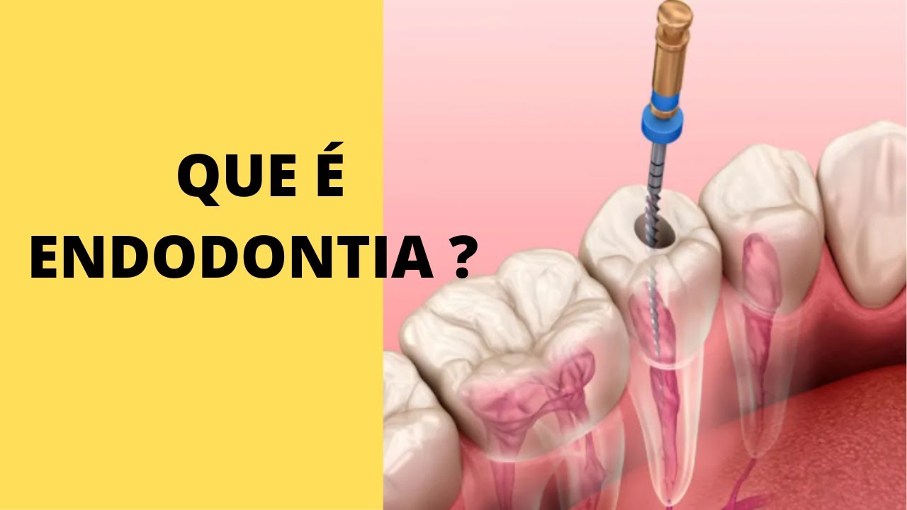 O QUE É ENDODONTIA E O QUE FAZ O ENDODONTISTA? @dr.alexguedes - YouTube