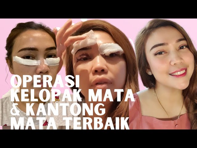 Operasi Kelopak Mata Dan Kantung Mata Nggak Pake Mahal Disini!! Dokternya Senior TerBaik Di Bandung! class=