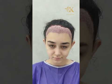 تصغير الجبهة للنساء بطريقة زراعة الشعر 